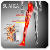 Sciatica Treatment + Symptoms Apk