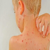 Chickenpox Apk