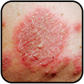 Skin Rash Cure Apk