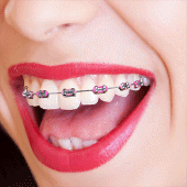 Braces Camera Apk